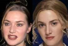 Після ринопластики (36 фото)